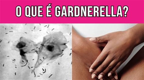 gardnerella é perigoso - diprogenta é antibiótico